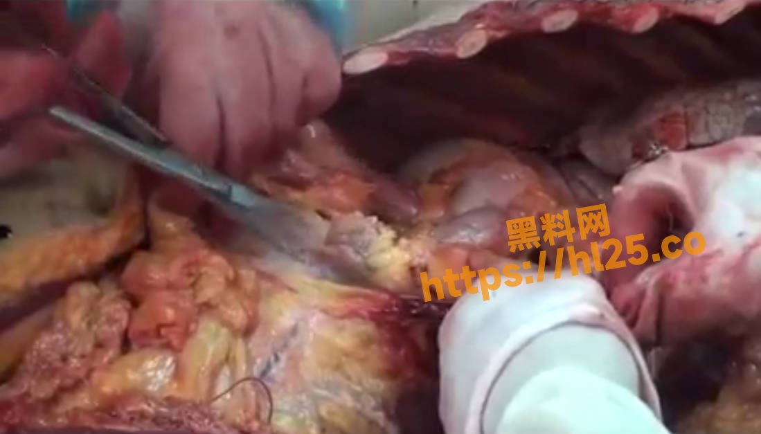 西安交通大学法医尸检讲座2！带你走近人体解剖的整个过程～重口慎入！